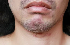 پسوریازیس