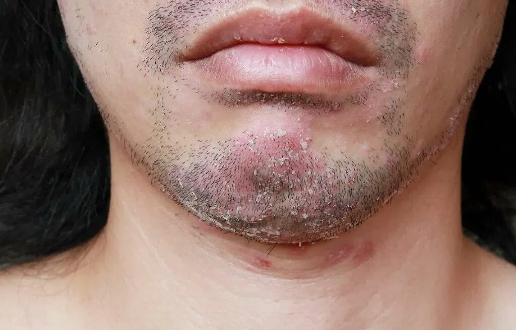 پسوریازیس
