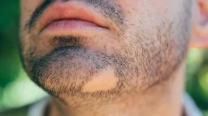 ریزش سکه‌ای مو،ابرو و ریش